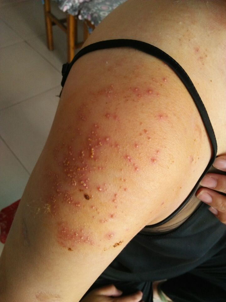 骨毒临床表现