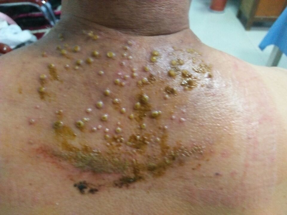 骨毒临床表现