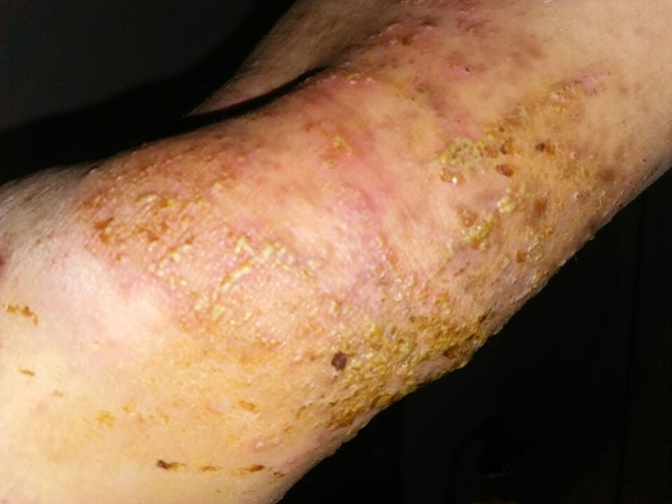 骨毒临床表现